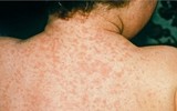 [ẢNH] Những loại bệnh dịch phổ biến do thời tiết ở Việt Nam